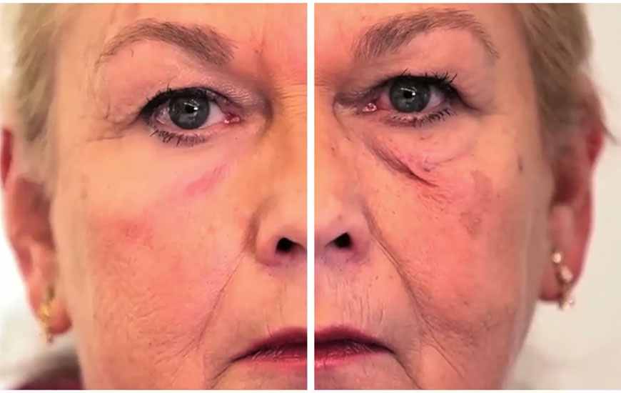‘Second Skin’ Covers Up Wrinkles